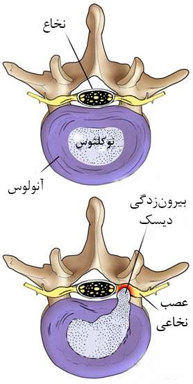 دیسک کمر کجاست؟ 